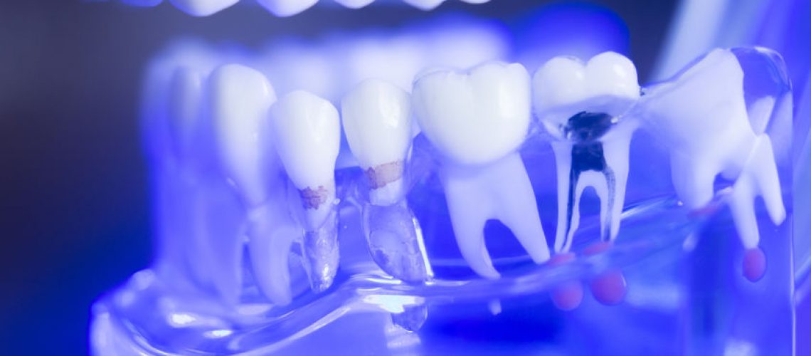 Dental teeth orthodontic dentistry teachng model with gums, tooth enamel, root nerve